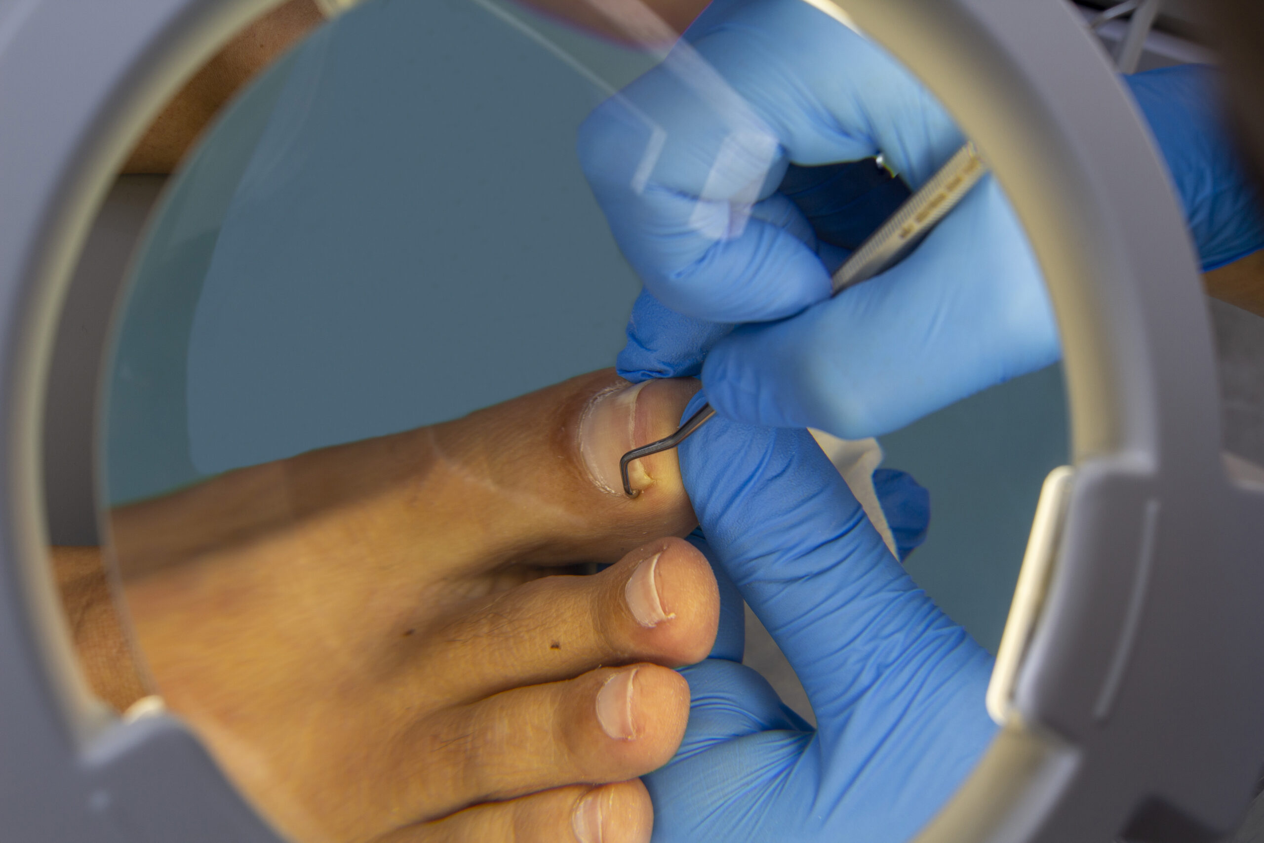 Plaatsing van een nagelbeugel